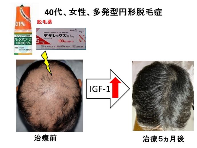 円形脱毛症　病院